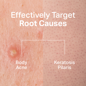 Anti-acne Body Wash
