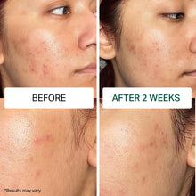 Multi-Action 5-Step Acne Care System