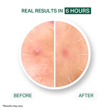 Acne Healing Patches